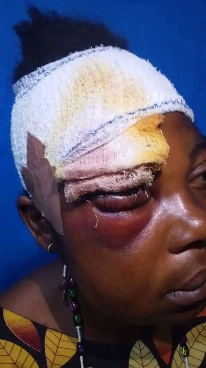 Landlady Attacks Widow Tenant in Ebonyi, Resulting in Partial Blindness